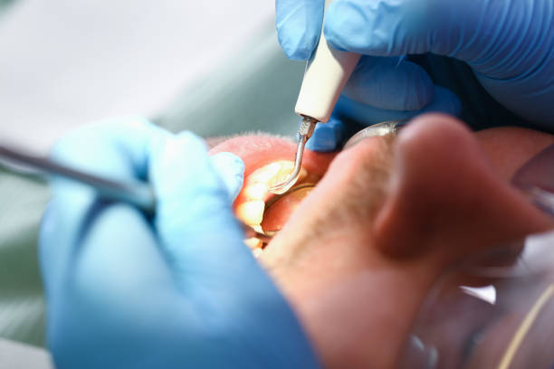 Best Emergency Wisdom Teeth Removal in Carpentersvle, IL