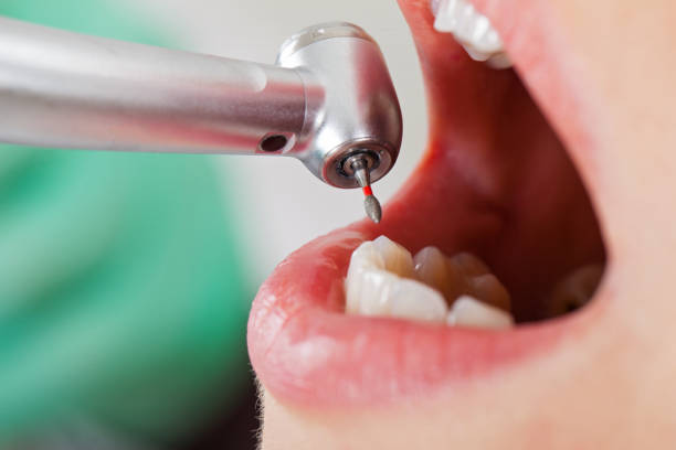 Best Emergency Wisdom Teeth Removal in Carpentersvle, IL